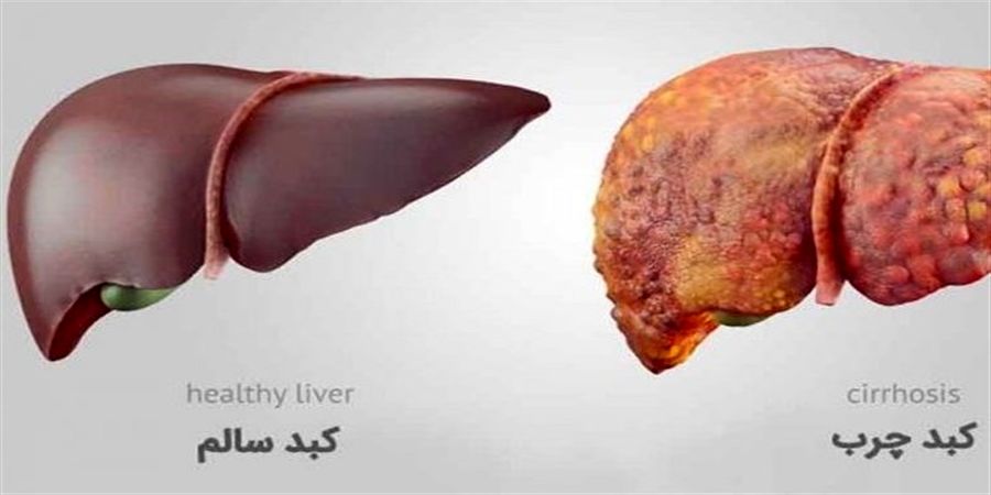 این افراد در معرض خطر ابتلا به کبد چرب غیر الکی هستند